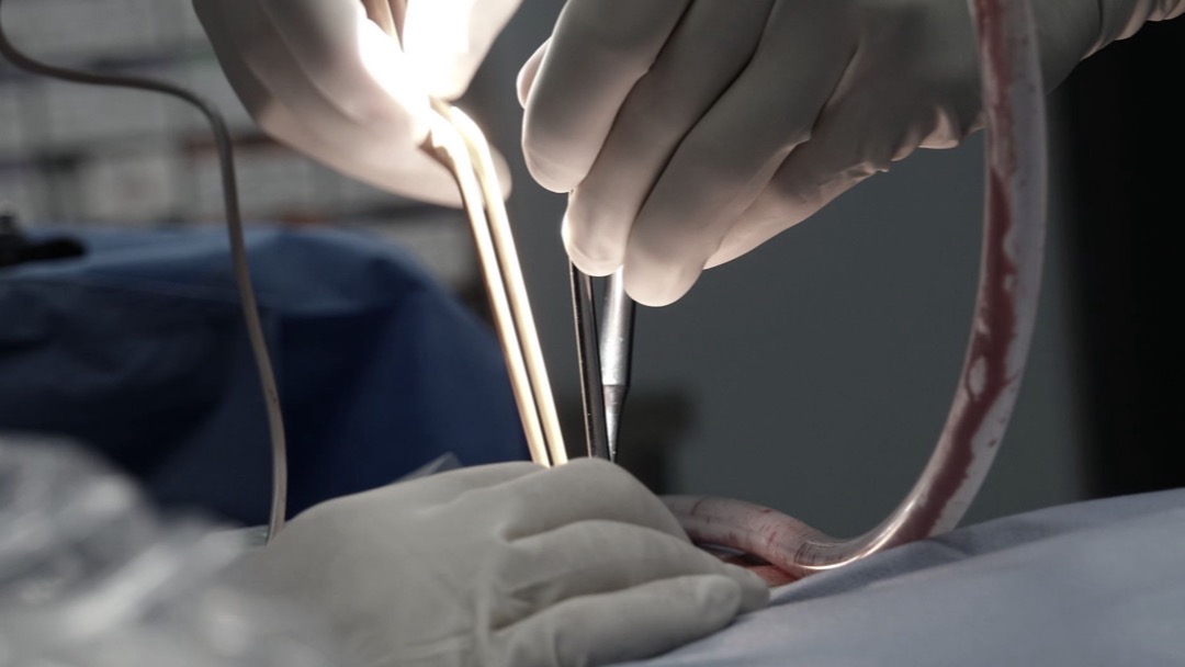 《中国成人重症急性胰腺炎早期局部并发症穿刺引流与微创清创介入专家共识（2026版）》发布，发热不是开腹的理由，四周内别急着清创